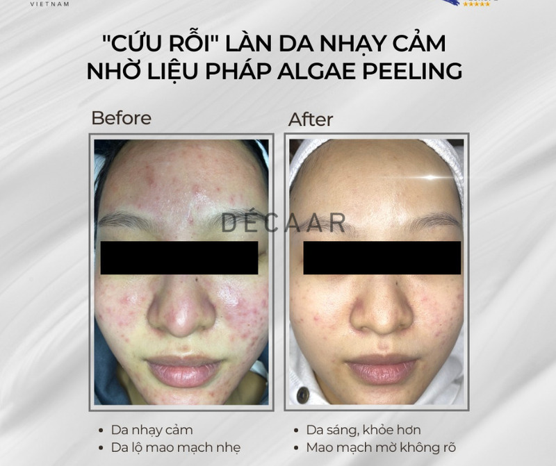 da nhạy cảm có nên peel da không